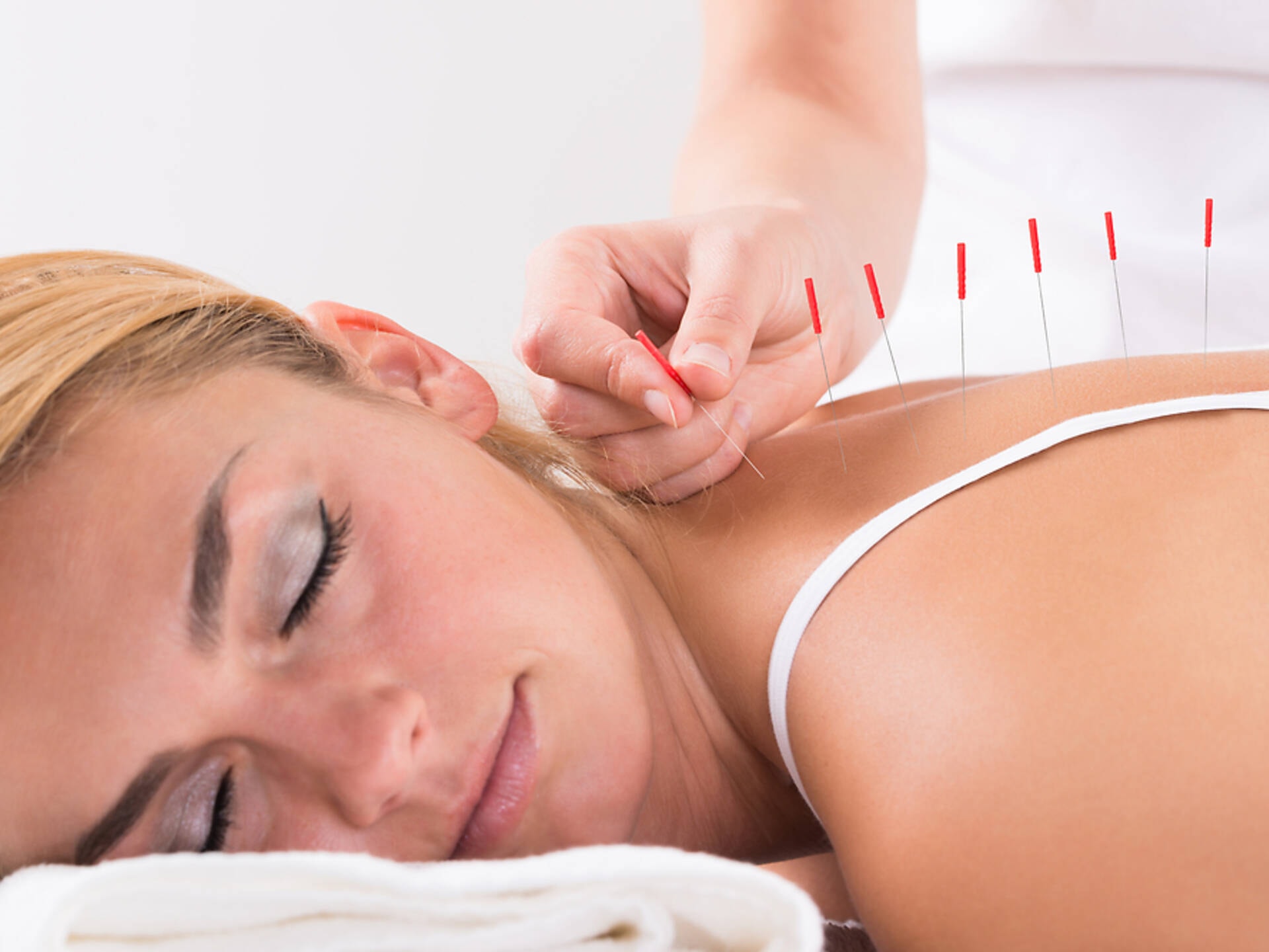 Acupuncture treatment